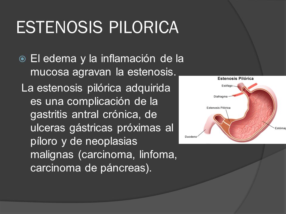 estenosis pilorica adquirida